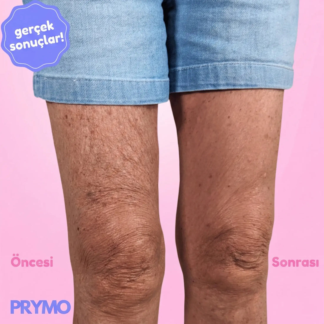 Pürüzsüzleştirici & Sıkılaştırıcı Selülit Bandı